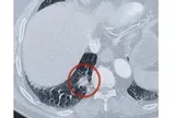 Tưởng mắc ung thư phổi, cụ ông 70 tuổi "thở phào" khi bác sĩ gắp ra thứ quen thuộc