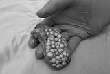 Đau bụng suốt 1 tháng, người phụ nữ 38 tuổi sốc khi bác sĩ lấy ra thứ "đáng sợ" trong bụng