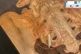 Đi khám sức khỏe, cô gái sốc khi phát hiện thứ "bất ngờ" nằm trong cơ thể suốt 22 năm