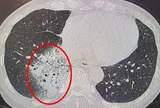 Người phụ nữ 40 tuổi "phổi trắng xoá" vì thói quen phổ biến này