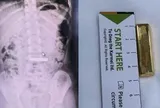 Bé gái 5 tuổi nuốt thỏi vàng dài 4cm vào bụng