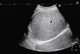 Người đàn ông 35 tuổi "gan trắng xóa" vì ngày nào cũng uống thứ nước "vạn người mê"