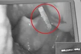Bé trai gần 4 tuổi khó chịu ở cổ, bố mẹ kinh ngạc khi bác sĩ gắp ra thứ "đáng sợ" bên trong