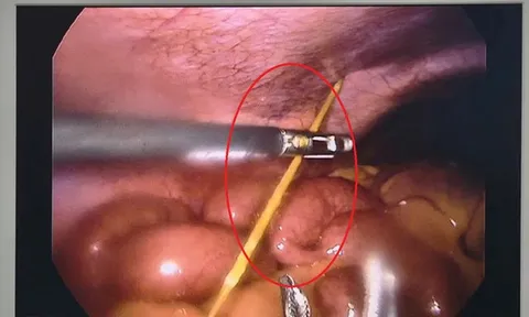 Đau bụng dữ dội, bác sĩ phát hiện thứ "đáng sợ" bên trong