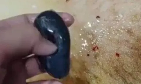 Nuốt mật cá sống để chữa đau đầu, người phụ nữ nhận kết đắng