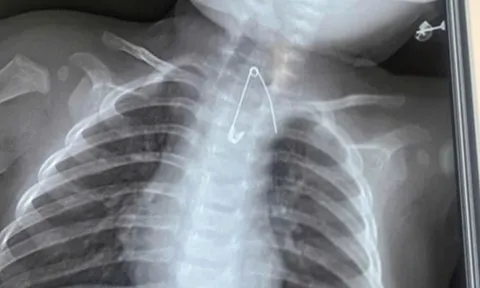 Bé 7 tháng tuổi khò khè kéo dài, bác sĩ phát hiện bí mật "đáng sợ"