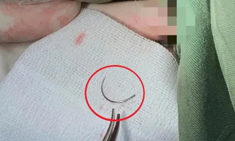 Kim khâu “mắc kẹt” suốt 11 năm trong cơ thể, người phụ nữ đến viện cầu cứu