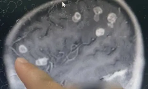 Bé gái sốt liên tục 17 ngày, bác sĩ sốc nặng khi phát hiện "bí mật" đáng sợ