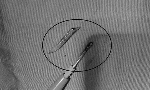 Người đàn ông 41 tuổi đau bụng, bác sĩ sốc phát hiện ra thứ đáng sợ "đi lạc" trong bụng