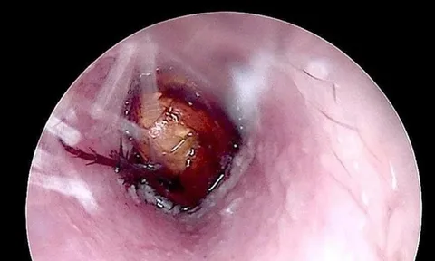 Cháu bé đau tai dữ dội, bác sĩ sốc ngang phát hiện bí mật "đáng sợ" bên trong