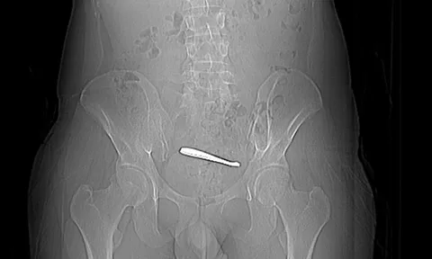 Người đàn ông đau bụng suốt 1 tuần, bác sĩ kiểm tra thì sốc nặng