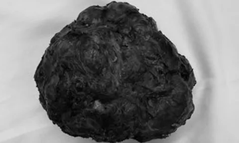 Cô gái trẻ 26 tuổi vòng một to bất thường, bác sĩ phát hiện bí mật bên trong