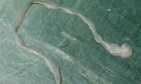 Người phụ nữ lên cơn co giật, bác sĩ lấy ra thứ đáng sợ trong não