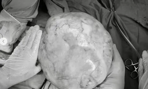 Bé gái 14 tuổi bụng to bất thường, bố mẹ sốc khi phát hiện bí mật "đáng sợ" bên trong