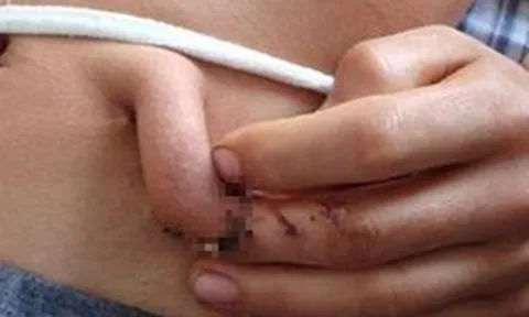 Người đàn ông 20 tuổi có ngón tay "mọc" ra từ ổ bụng, sự thật phía sau gây bất ngờ