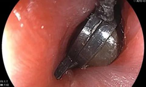 Bé 5 tuổi đau bụng dữ dội, bố mẹ sốc khi bác sĩ gắp ra thứ "đáng sợ" bên trong