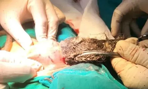 Phẫu thuật lấy búi tóc dài gần 20cm trong dạ dày bé trai 4 tuổi, do bé mắc bệnh lạ