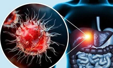 Không rượu bia, gan vẫn có thể tổn thương nặng vì lý do ít ai ngờ
