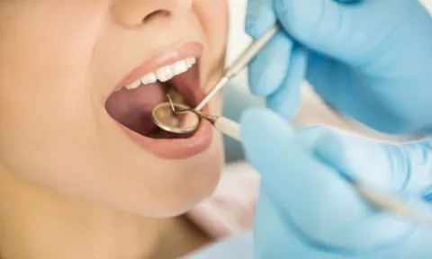 Lấy cao răng có được hưởng bảo hiểm y tế?