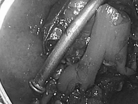 Bé trai 8 tuổi nghịch dại, bác sĩ kinh ngạc phát hiện thứ "đáng sợ" bên trong bụng