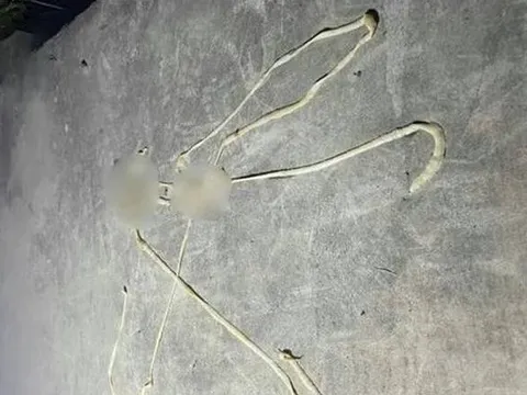 Bị rối loạn tiêu hóa, người đàn ông phát hiện "vật thể lạ" dài gần 10m