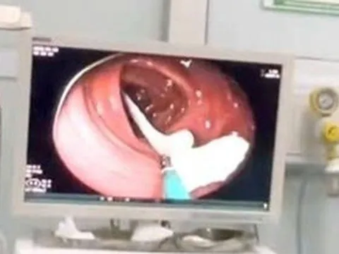 Người đàn ông 35 tuổi sốc nặng khi thấy ký sinh trùng "khổng lồ" đang sống trong ruột