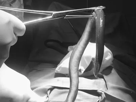 Bụng "cứng như gỗ", người đàn ông sốc nặng khi biết có con vật bơi trong bụng mình