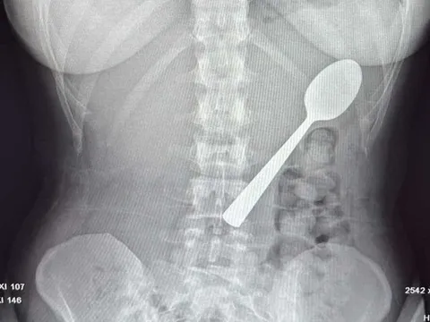 Đang ăn sữa chua, người phụ nữ nuốt chiếc thìa dài 17cm vào bụng