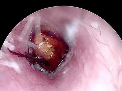 Cháu bé đau tai dữ dội, bác sĩ sốc ngang phát hiện bí mật "đáng sợ" bên trong
