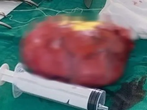 Đau bụng tưởng nhẹ, người phụ nữ sốc nặng khi bác sĩ lấy ra thứ “đáng sợ” trong bụng