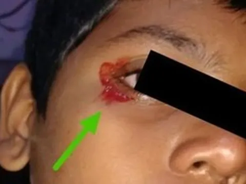 Bé trai 11 tuổi khóc ra máu khiến bác sĩ kinh ngạc